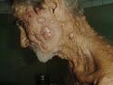Linfoma Cutaneo | Patologias Dermatologicas